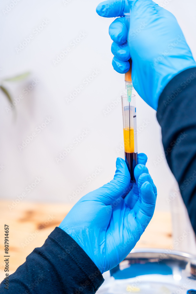 Nurse extracting centrifuged blood to inject it into baldness treatment Nurse extracting centrifuged blood to inject it into baldness treatment