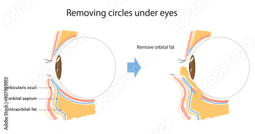 くまとり_removing bags