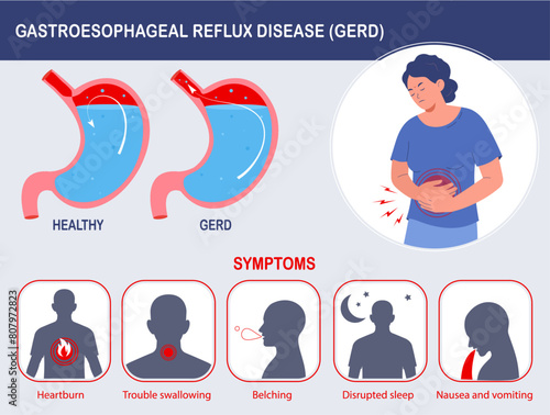 Gastroesophageal Reflux Disease (GERD) infographic. GERD symptoms. Medical info poster. Flat cartoon vector illustration	