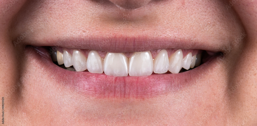 Fototapeta premium tooth restorations with emax ceramic crowns and veneers