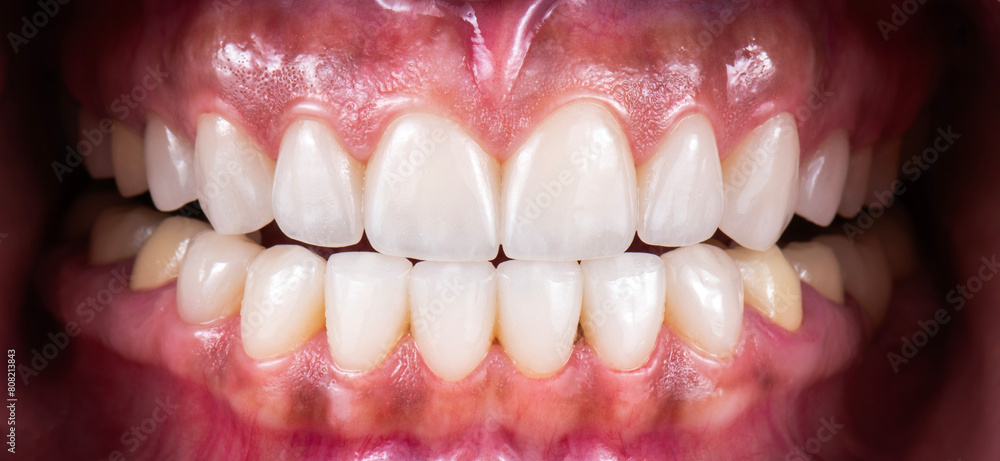tooth restorations with emax ceramic crowns and veneers tooth restorations with emax ceramic crowns and veneers