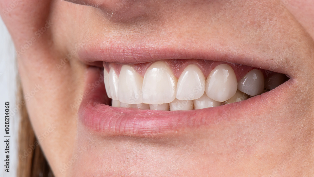 Obraz premium tooth restorations with emax ceramic crowns and veneers