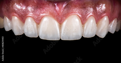 tooth restorations with emax ceramic crowns and veneers photo