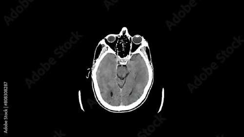 Brain CT. Axial view. Hypodens lacunar zone in the area of right lentiform nucleus, enlarged perivascular space. No intracranial hemorrhage and loss of brain parenchyma. photo