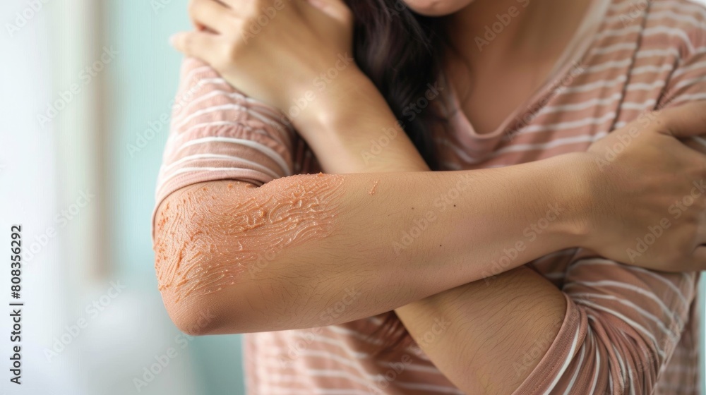 Close shot of a women scratching her arm. Itching, eczema, allergy.
Close shot of a women scratching her arm. Itching, eczema, allergy.