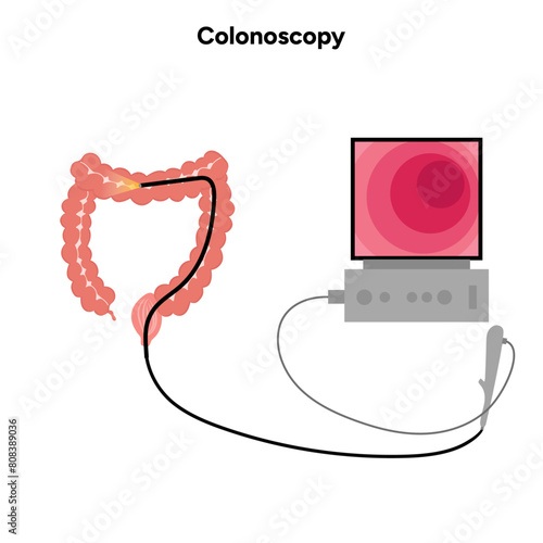 Colonoscopy procedure 