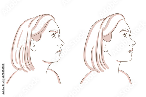 Reduce double chin, jawline plastic and cosmetology. Get rid of face and neck fat before and after concept.