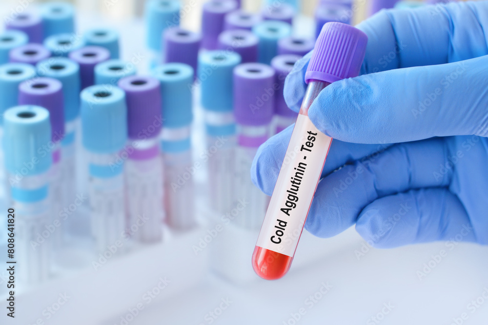 Doctor holding a test blood sample tube with cold agglutinin test on the background of medical test tubes with analyzes. Doctor holding a test blood sample tube with cold agglutinin test on the background of medical test tubes with analyzes.