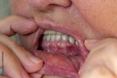 A view of an open mouth with inflamed gums