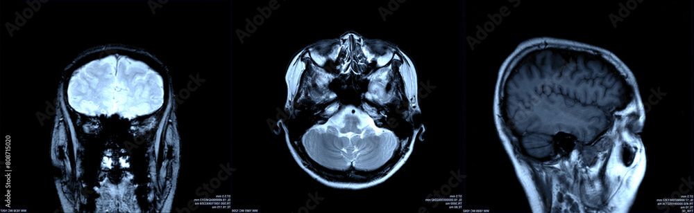 Φωτογραφία Magnetic resonance imaging of the brain
