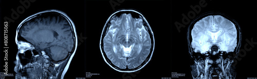 Brain x-ray images scan by mri or ct scan. radiology or radiograph concept.