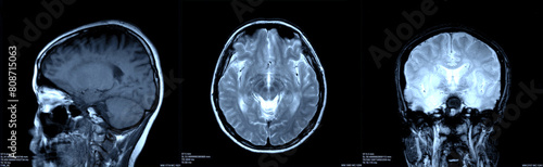 Foto Brain x-ray images scan by mri or ct scan