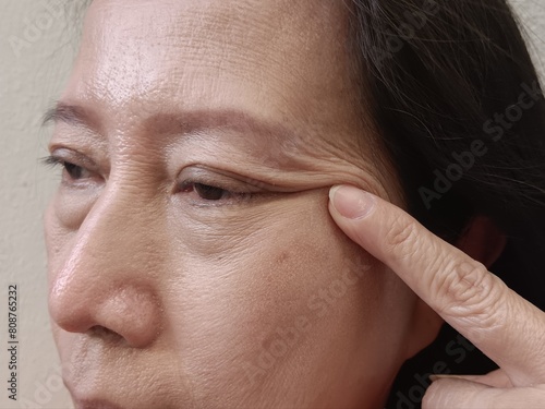 
A middle-aged woman has wrinkles on her face and large bags under her tears