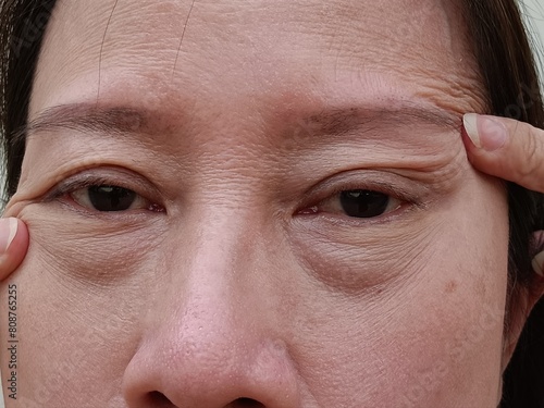 

A middle-aged woman has wrinkles on her face and large bags under her tears