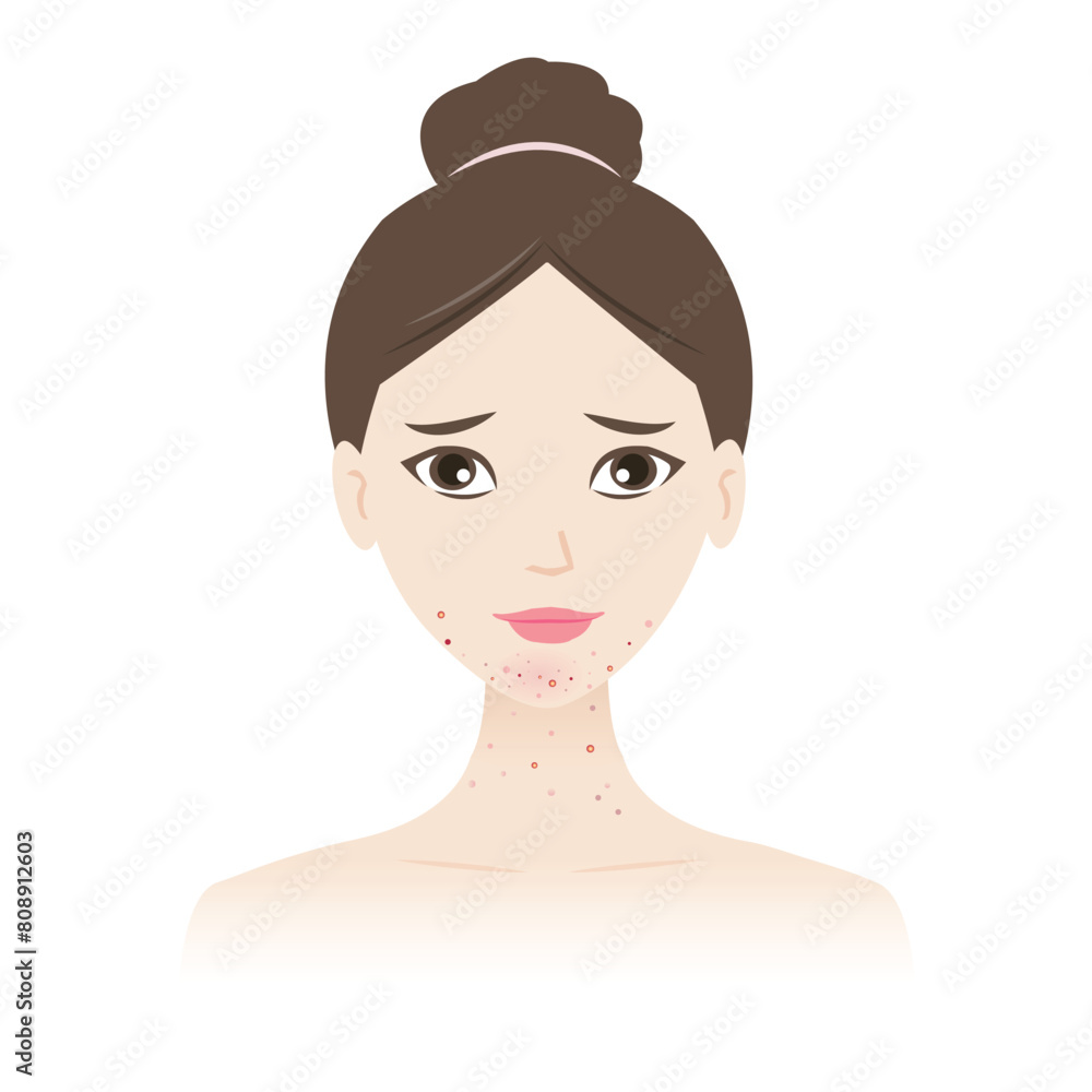 The woman with acne on jawline and neck vector isolated on white background. Acne, pimples, blackheads, comedones, whiteheads, papule, pustule, nodule, cyst on face and neck. Skin problem. The woman with acne on jawline and neck vector isolated on white background. Acne, pimples, blackheads, comedones, whiteheads, papule, pustule, nodule, cyst on face and neck. Skin problem.