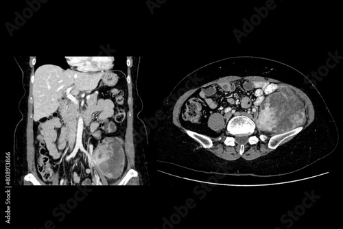 CT images show a Left retroperitoneal mass with a peripheral fatty component with thin septa and poorly defined solid-appearing areas with no clear demarcation between them and fat.