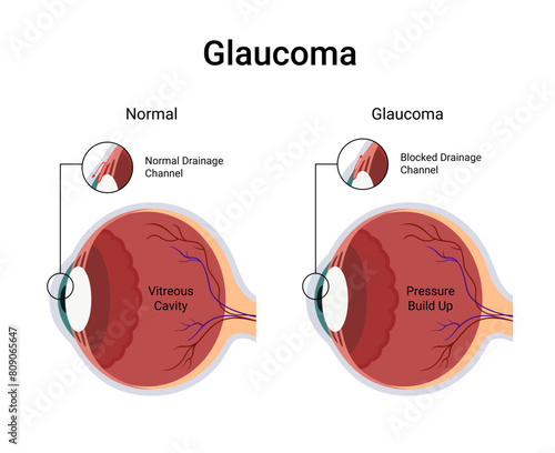 Diagram of glaucoma affected human eye and normal eye