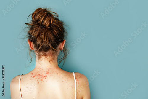 Female Back with Painful Rash, Red Spots Blisters on a Skin. Human Body with Health Problem. Monkeypox, Monkey Pox Disease Symptoms. Close Up Patient. Banner, Copy Space. Dengue Fever Infection, MPOX.