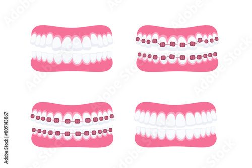Teeth with braces. Orthodontic treatment. Tooth braces. Teeth with metal brackets