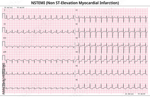 Non ST-Elevation Myocardial Infarction (NSTEMI) - ECG Paper 12 Lead - 6 Sec/lead - Medical Vector Illustration 