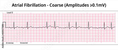 Coarse Atrial Fibrillation - 8 Second ECG Paper - Electrocardiography Vector Medical Illustration photo
