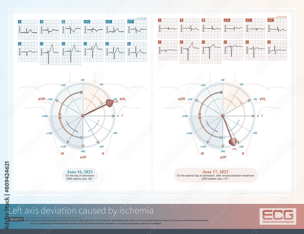 When acute myocardial ischemia occurs in the left ventricle, the ...