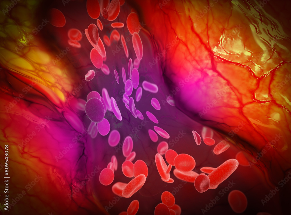 Venous thrombosis caused by the use of the vaccine. Microscopic view of ...