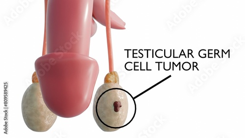 Tableau sur toile 3D Rendering of Testicular cancer happens when cells in the testicle grow to for