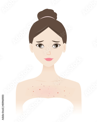 The woman with acne on chest vector illustration isolated on white background. Acne, pimples, blackheads, comedones, whiteheads, papule, pustule, nodule and cyst on body. Skin problem concept.