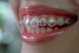 Intimate view of a person's journey with dental braces, capturing the subtle changes towards a perfect smile 