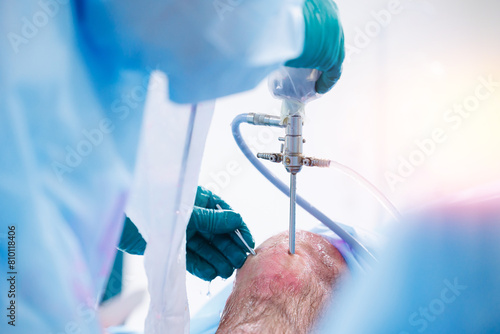 Surgeon use laparoscopic instrument for leg patient minimally invasive surgery. Suturing tendons and ligaments in knee of man, operating hospital