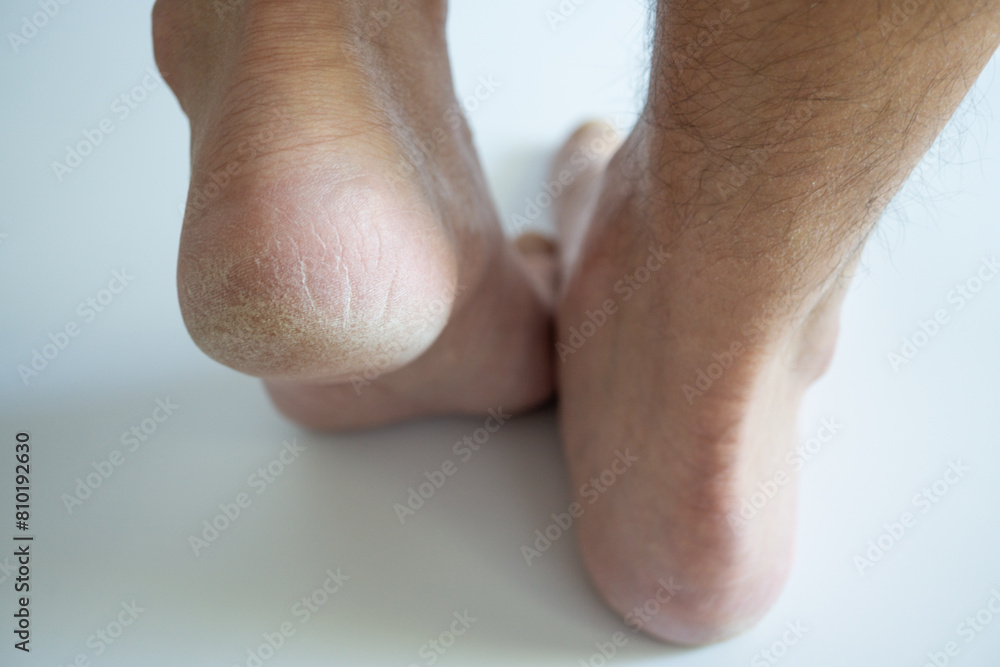 cracked feet heels close up - cornea skin - cracked men feet on white background - calluses callus, horny skin cracked feet heels close up - cornea skin - cracked men feet on white background - calluses callus, horny skin