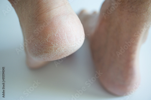 cracked feet heels close up - cornea skin - cracked men feet on white background - calluses callus, horny skin photo