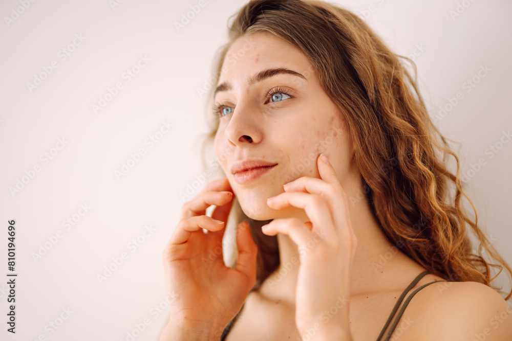 A young woman with bad skin. Skin with a lot of pimples. Acne disease, acne treatment. Medicine and cosmetology. A young woman with bad skin. Skin with a lot of pimples. Acne disease, acne treatment. Medicine and cosmetology.