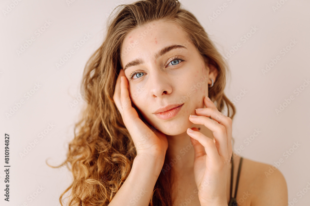 A young woman with bad skin. Skin with a lot of pimples. Acne disease, acne treatment. Medicine and cosmetology. A young woman with bad skin. Skin with a lot of pimples. Acne disease, acne treatment. Medicine and cosmetology.