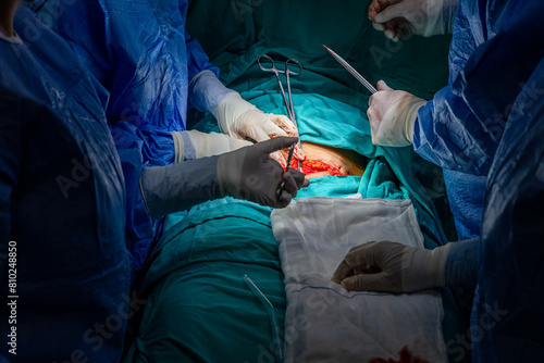 Surgeons performing cesarean section in operating room. Birth surgery with Caesarean. New life, baby being born via Caesarean Section in the operating room (mature content). photo