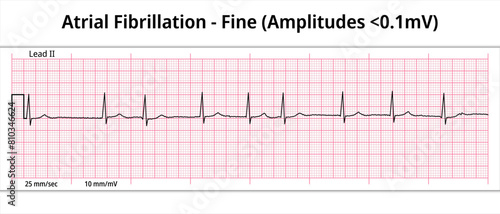 Fine Atrial Fibrillation - 8 Second ECG Paper - Electrocardiography Vector Medical Illustration photo