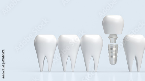 The dental implants for health and medical concept 3d rendering.