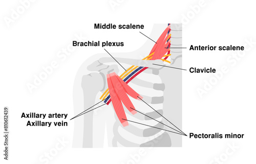 Vector illustration of where thoracic outlet syndrome occurs