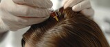 Hair regeneration treatment with plasma injections on a womans head, administered by a cosmetologist