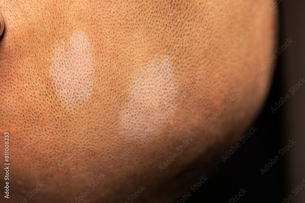 Fototapeta premium Hypomelanotic macule on the scalp in tuberous sclerosis