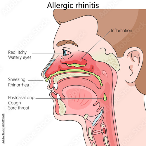 Allergic rhinitis, showing symptoms like sneezing, watery eyes, and inflammation diagram hand drawn schematic vector illustration. Medical science educational illustration