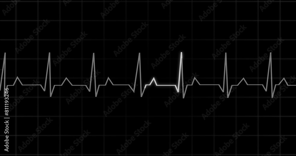 Naklejka premium EKG Heartbeat reading animation on black background. Medical monitor displaying cardiography pulse checkup diagnosis electronic screen display machine. Cardiogram nubes rate ecg waveform surgery.