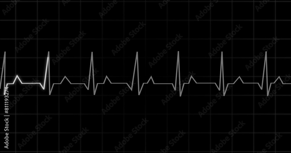 EKG Heartbeat reading animation on black background. Medical monitor displaying cardiography pulse checkup diagnosis electronic screen display machine. Cardiogram nubes rate ecg waveform surgery.