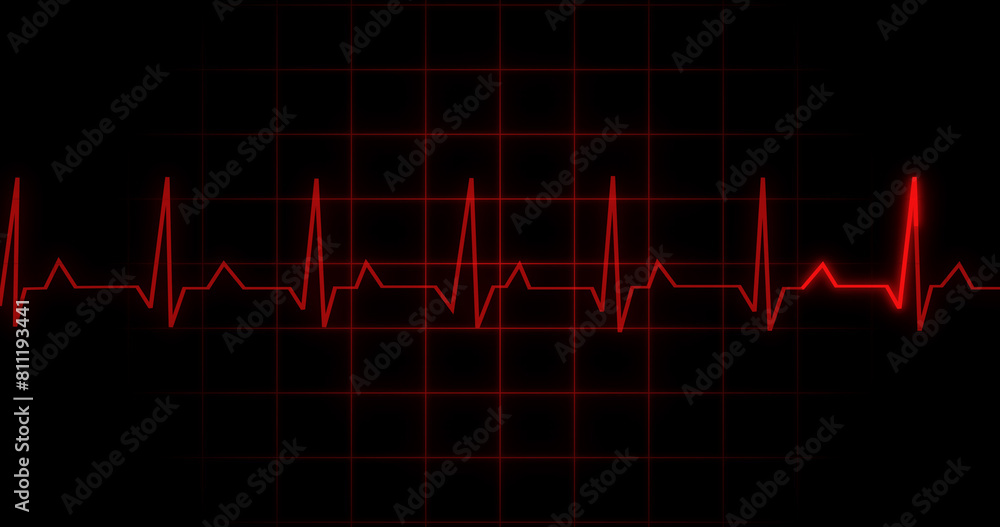 EKG Heartbeat reading animation on black background. Medical monitor displaying cardiography pulse checkup diagnosis electronic screen display machine. Cardiogram nubes rate ecg waveform surgery. EKG Heartbeat reading animation on black background. Medical monitor displaying cardiography pulse checkup diagnosis electronic screen display machine. Cardiogram nubes rate ecg waveform surgery.