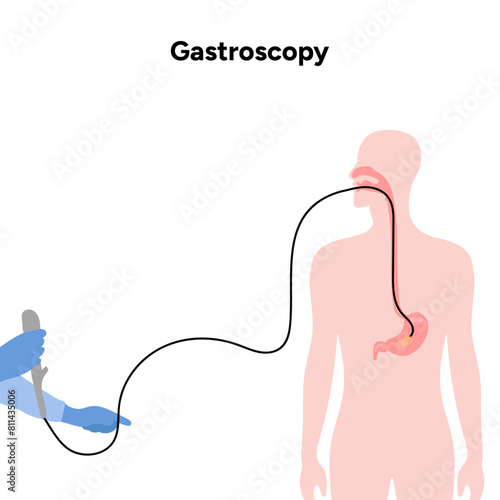 Gastroscopy procedure 
