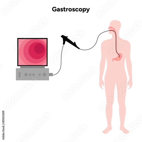 Gastroscopy procedure 