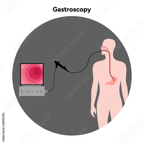 Gastroscopy procedure 