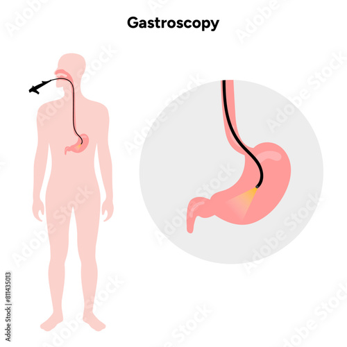 Gastroscopy procedure 