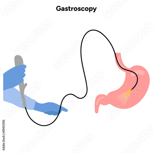 Gastroscopy